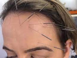 Craniopuntura de Yamamoto - (YNSA)